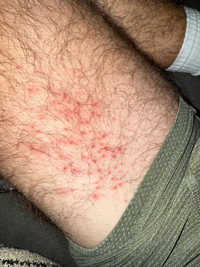 The rash, 2023